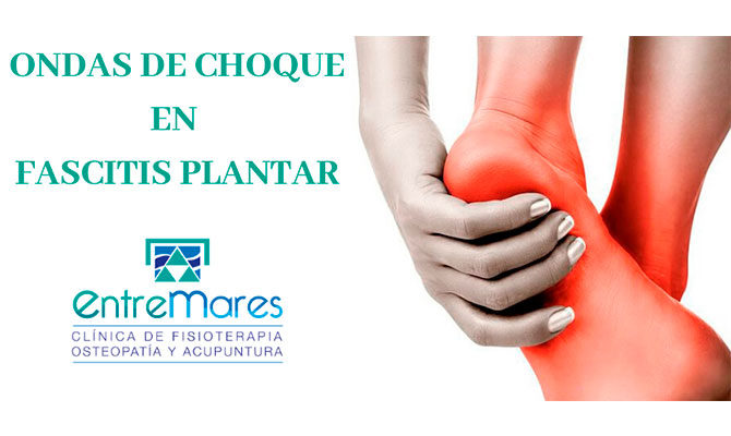 Ondas de Choque para la Fascitis Plantar