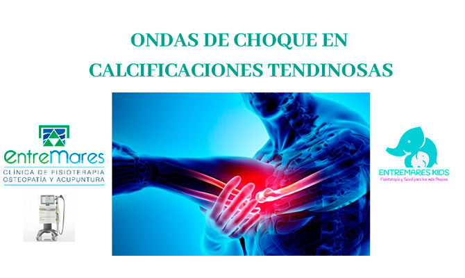 ONDAS DE CHOQUE EN CALCIFICACIONES TENDINOSAS