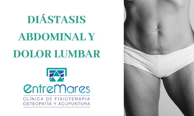 DIÁSTASIS ABDOMINAL Y DOLOR LUMBAR