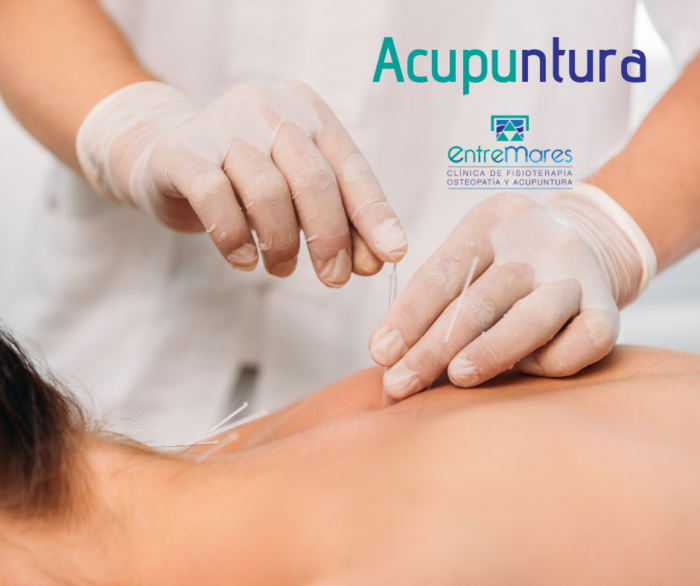 acupuntura torrevieja
